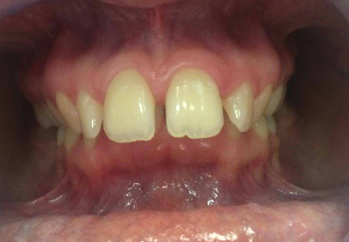 Így nézett ki a fogsorom mielőtt felrakta Fruzsi a fogszabályozót