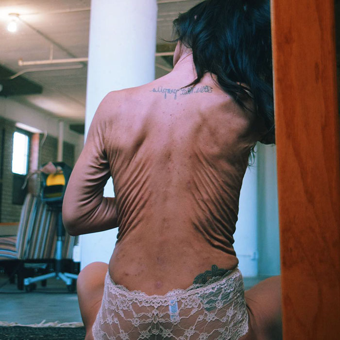 Nem fél megmutatni testét a ritka bőrbetegségben szenvedő nő