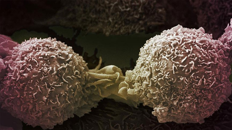 Tüdőrákos sejtek - a génterápia segítségével a jövőben ez a daganat is kezelhetővé válhat (Fotó: Novartis)