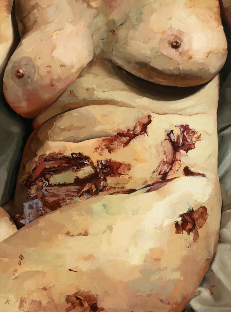 Így néz ki az endometriózis húsbavágó festményeken