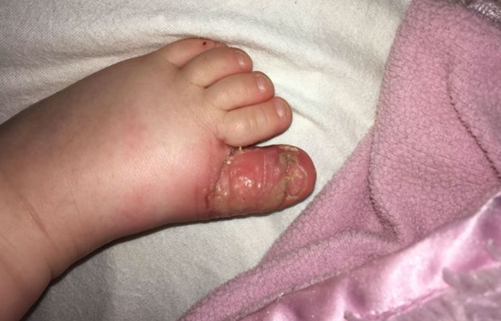 Kutyapisitől kaphatott életveszélyes fertőzést a 18 hónapos kislány 