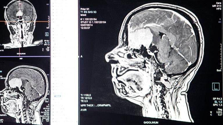 MRI-felvétel az agyról (forrás: AFP)