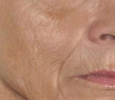 Így öregszik az arc – Arcfiatalító kezelés ami segíthet!