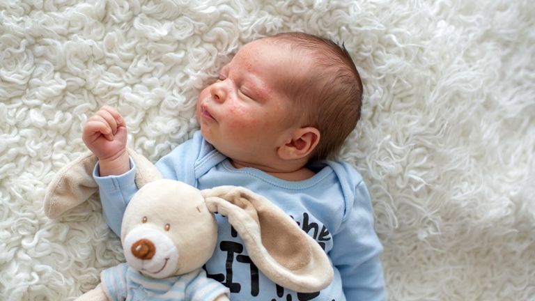 Tévhitek a csecsemőkori ekcémáról – amit minden szülőnek jó tudni