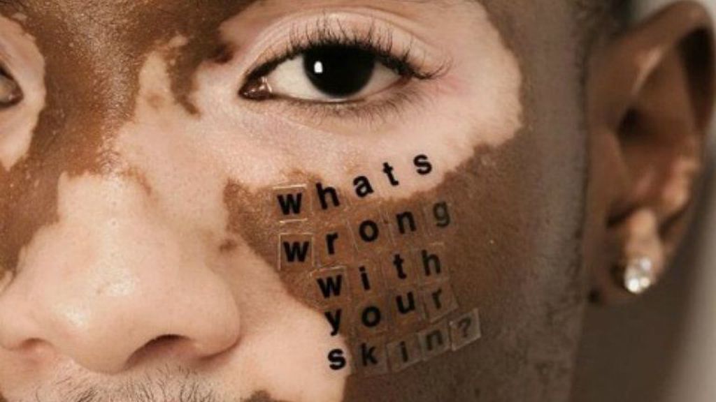 vitiligo, borbetegseg