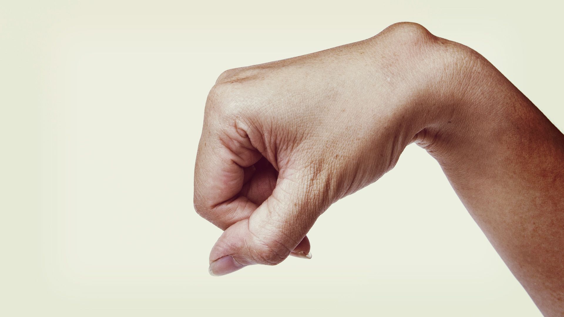 Ganglion (csuklón és kézen előforduló gömbszerű duzzanat) előfordulása és kezelése gyermekkorban