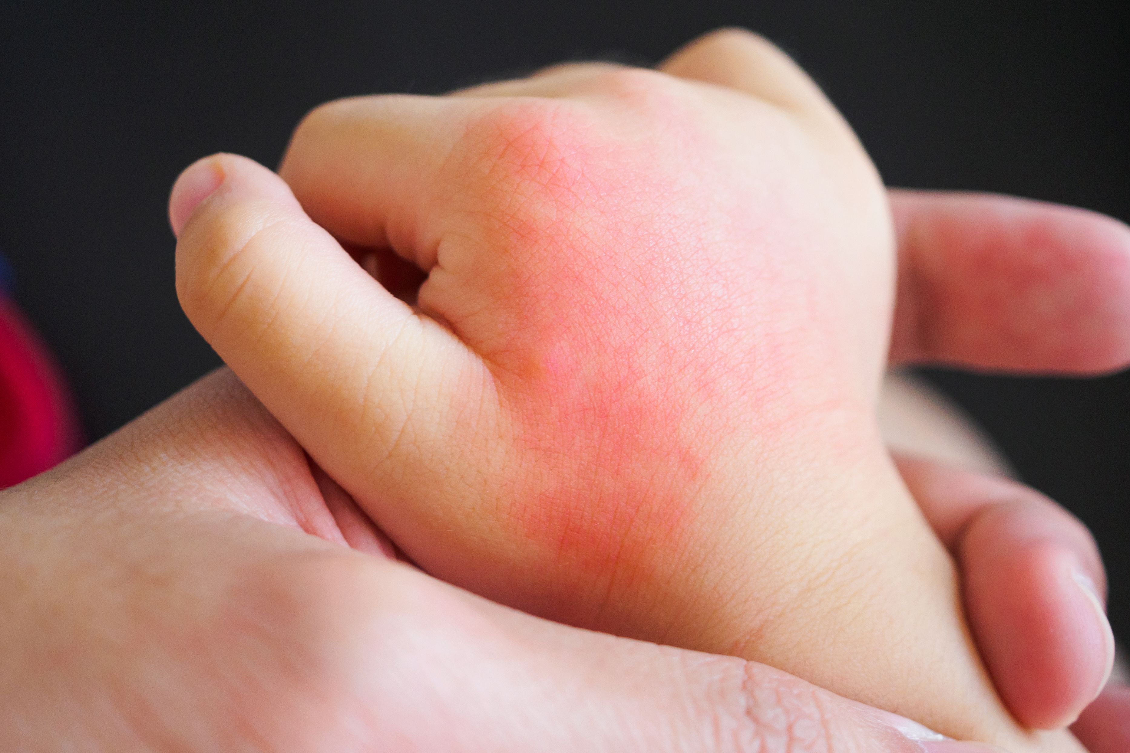 Gyermekkori ekcéma - Gyermekkori atópiás dermatitis