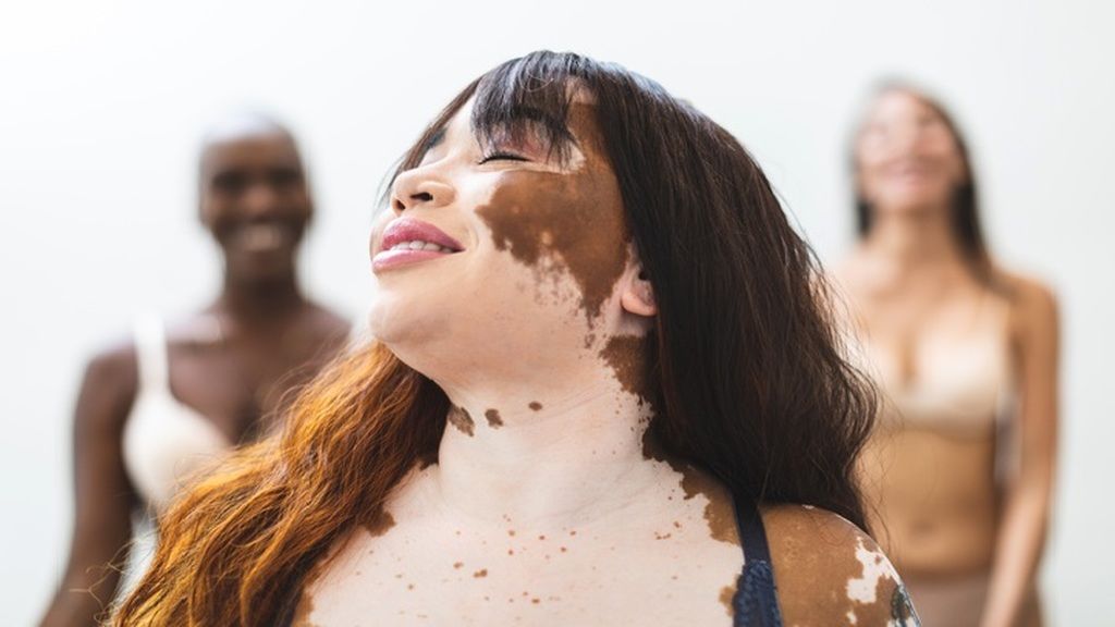 Nők, akik büszkén vállalják vitiligójukat