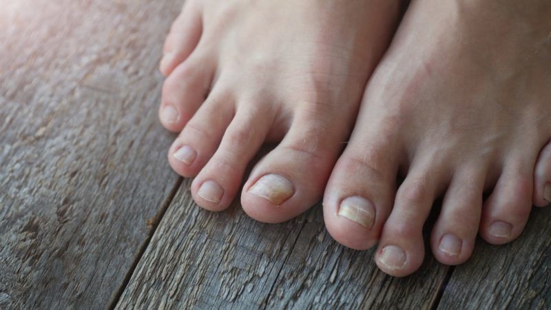 ahol lehet kapni fertőzött köröm gomba nail foot gomba kezelés készítmények