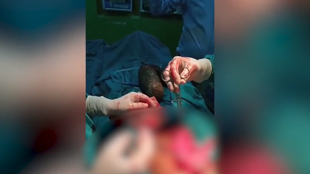 7kilós hajcsomót operáltak ki a tini gyomrából.