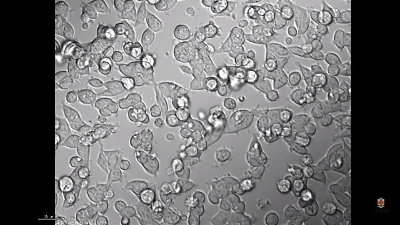 Gömbformájúvá alakítja a koronavírus a sejtjeinket - videó