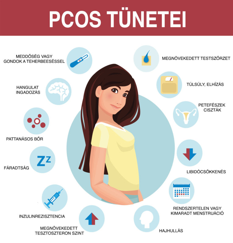 PCOS: tünetek, kezelés, diéta és hasznos tanácsok