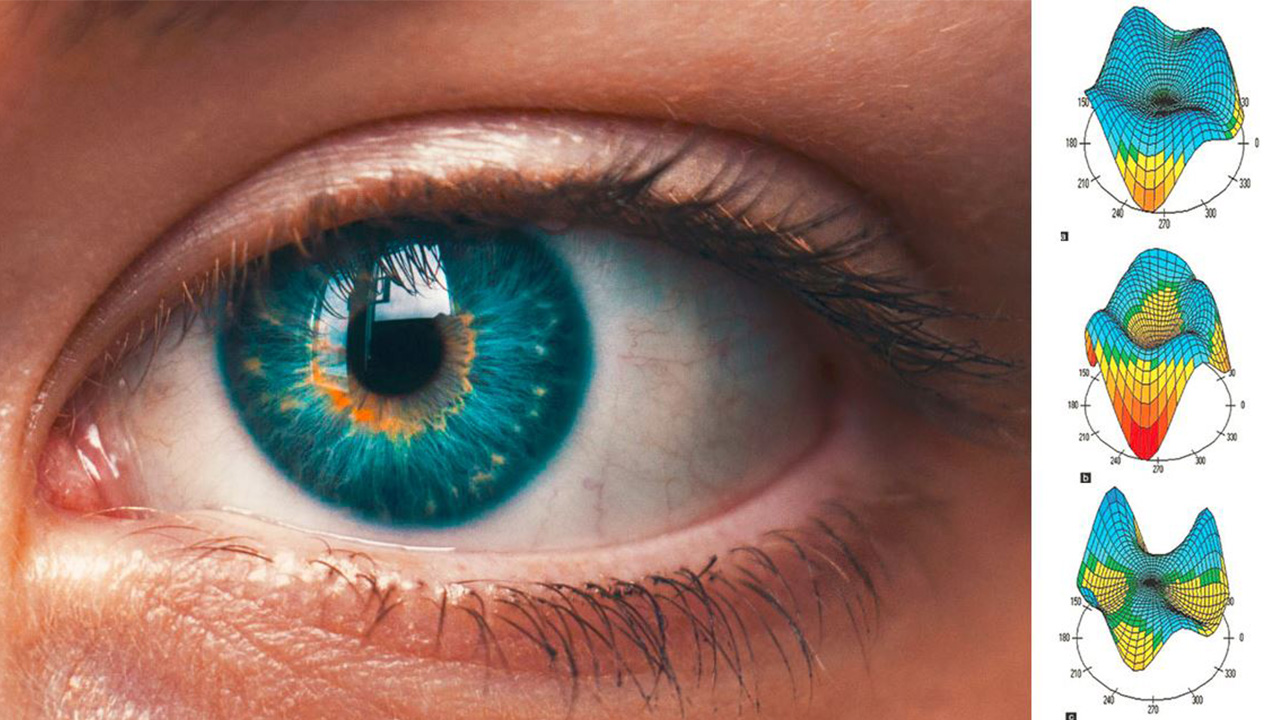 A lézeres szemműtétet megelőző alkalmassági vizsgálat során 200-300 ezer adat készül a szemről