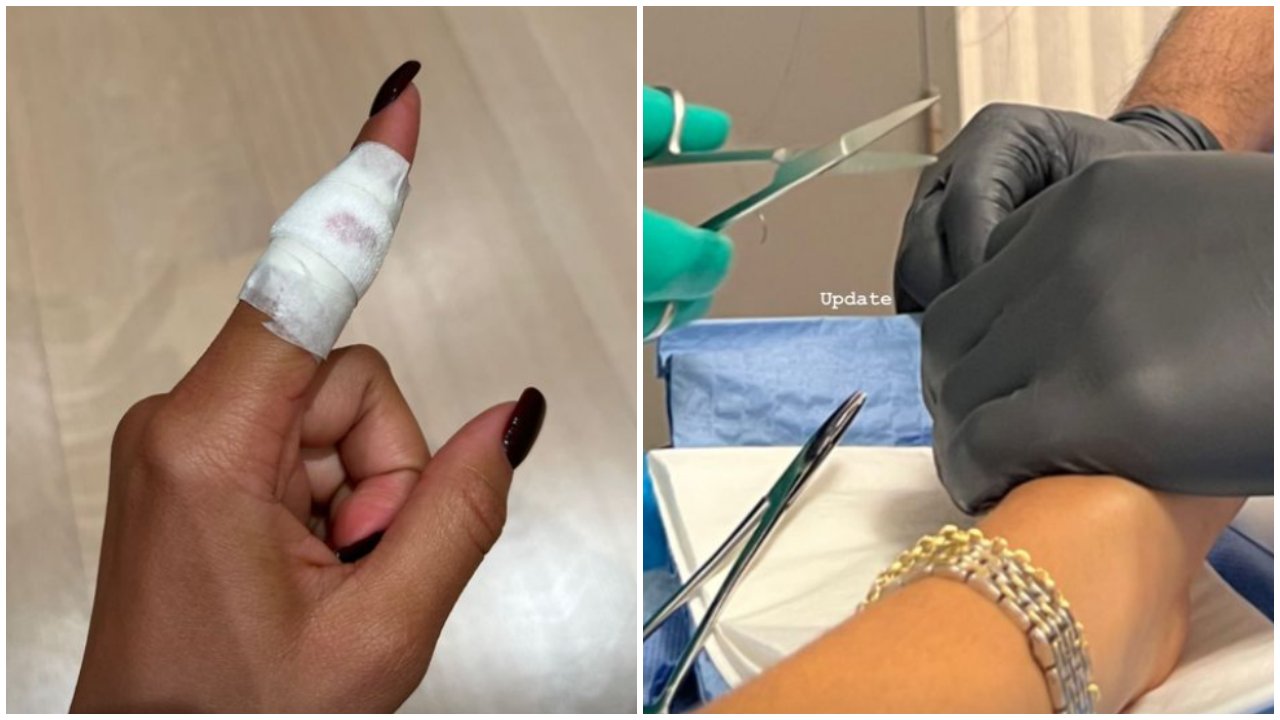 A montázson Zendaya bekötözött ujja, és ahogy bevarjják a sebét az orvosok