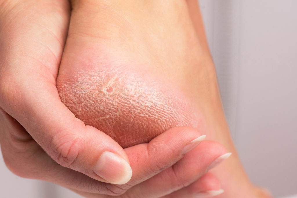 lábápolás pedikűr sarokrepedés száraz bőr lábkrém