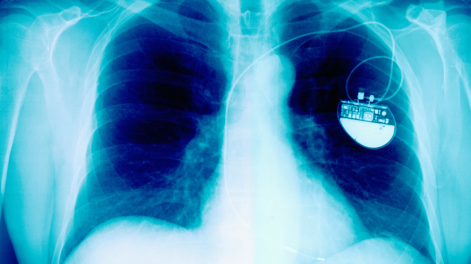 Pacemaker (szívritmus-szabályozó) a röntgenfelvételen