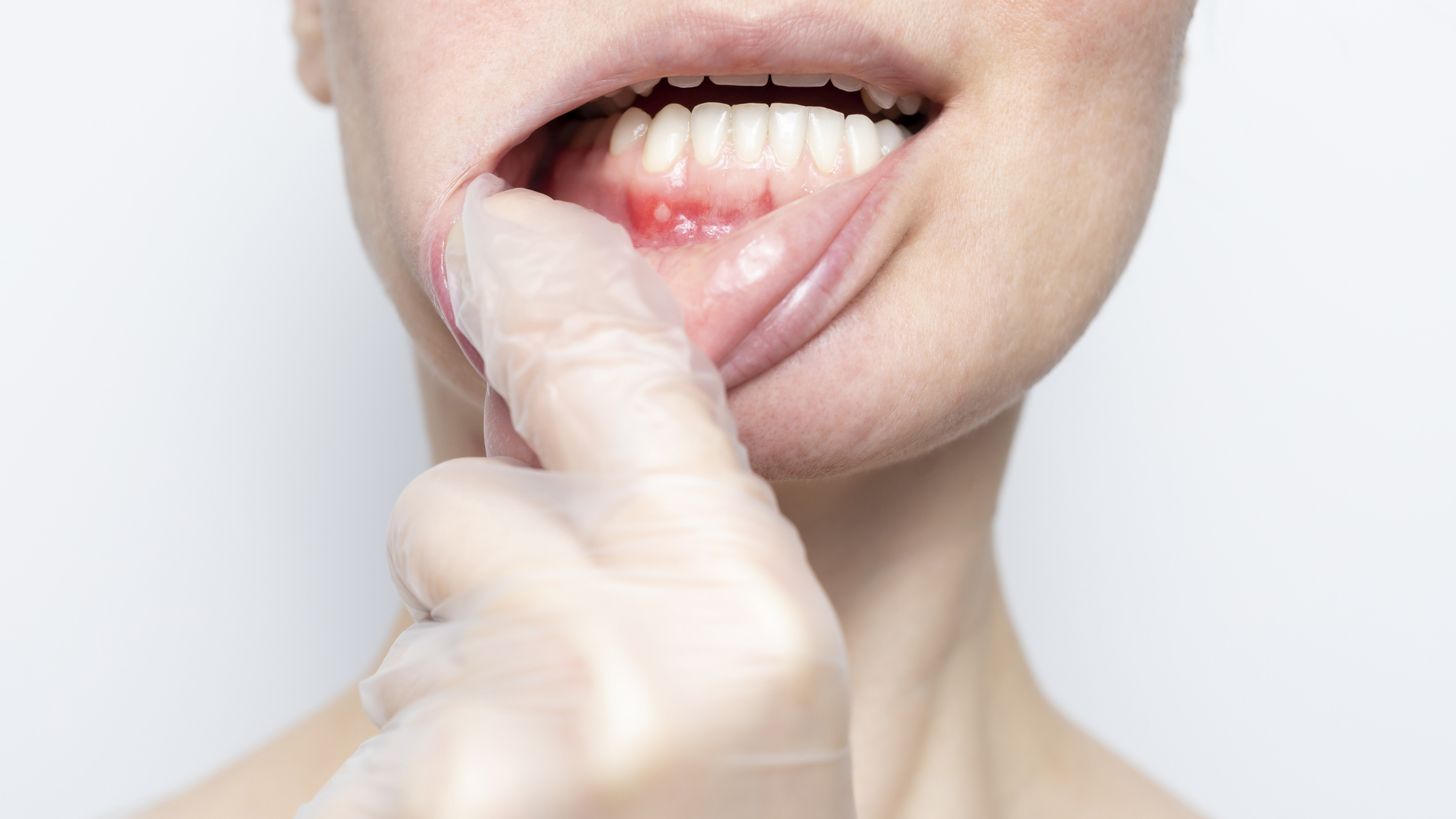 Egy nő a szájában fellelhető aftát mutatja