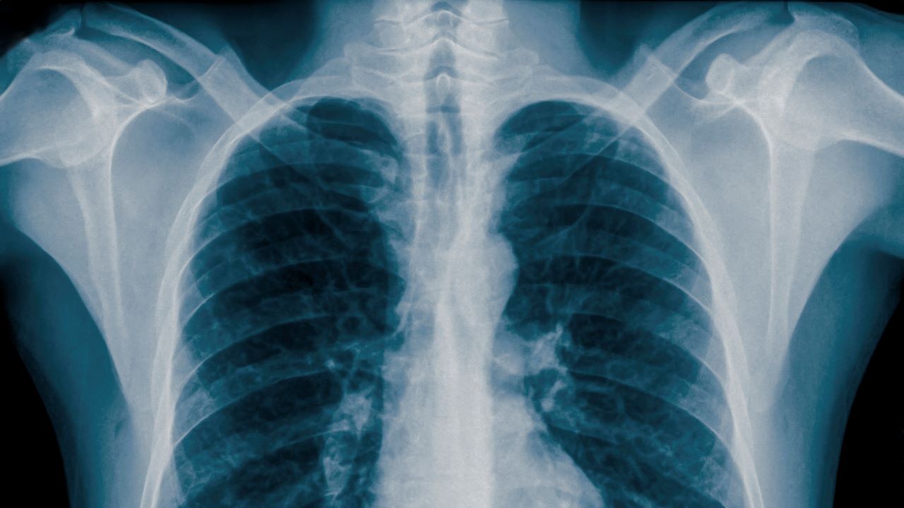 Hátborzongató dolgot találtak a mellkasröntgenen.
