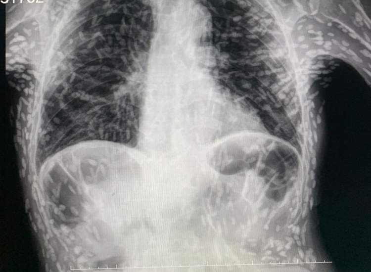 hátborzongató dolog jelent meg a mellkasröntgenen