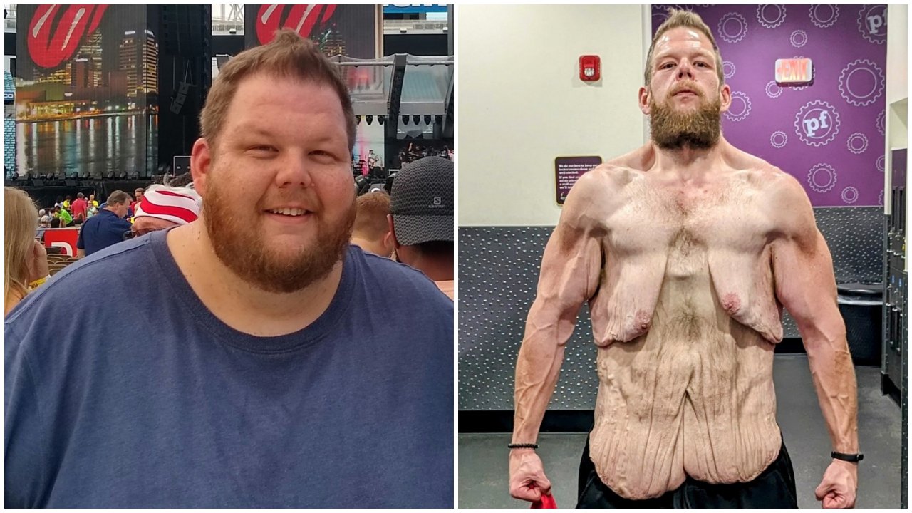 Cole Prochaska 265 kilósan, valamint nagy fogyása után, 100 kilósan, megereszkedett bőrrel