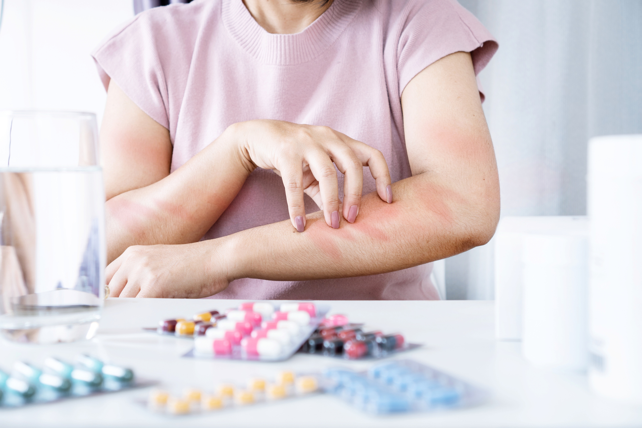 Egy asztalnál ülő nő vakarja vörös foltos karját, az előtte lévő asztalon különböző allergiás gyógyszerek vannak.