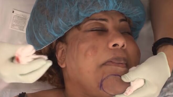 Betonnal töltötte fel egy nő arcát az olcsó „plasztikai sebész”