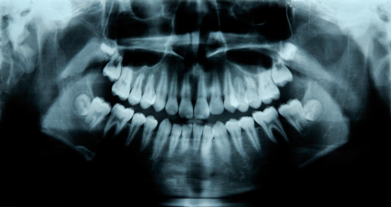 Kiderült, hány foga van a világ legtöbb fogú emberének