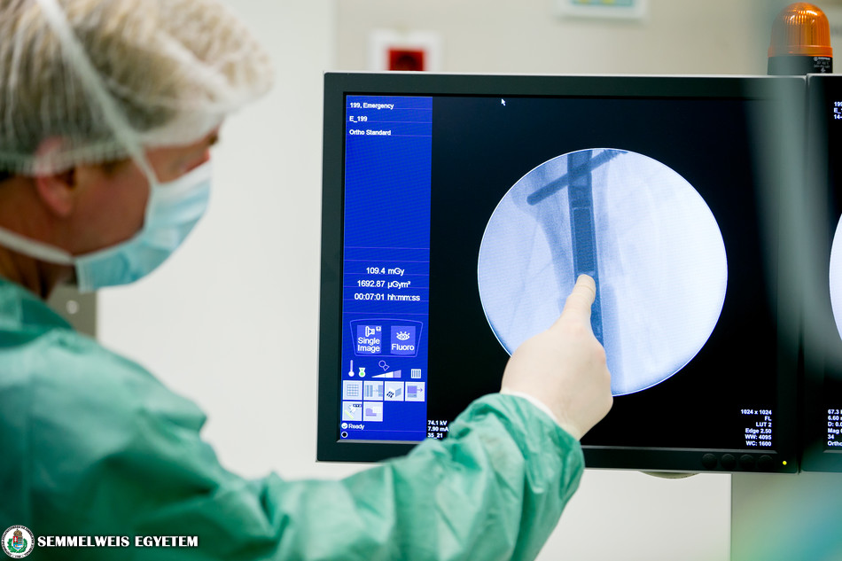 Csonton belüli végtaghosszabbításról készült röntgenfelvétel a Semmelweis Egyetemen