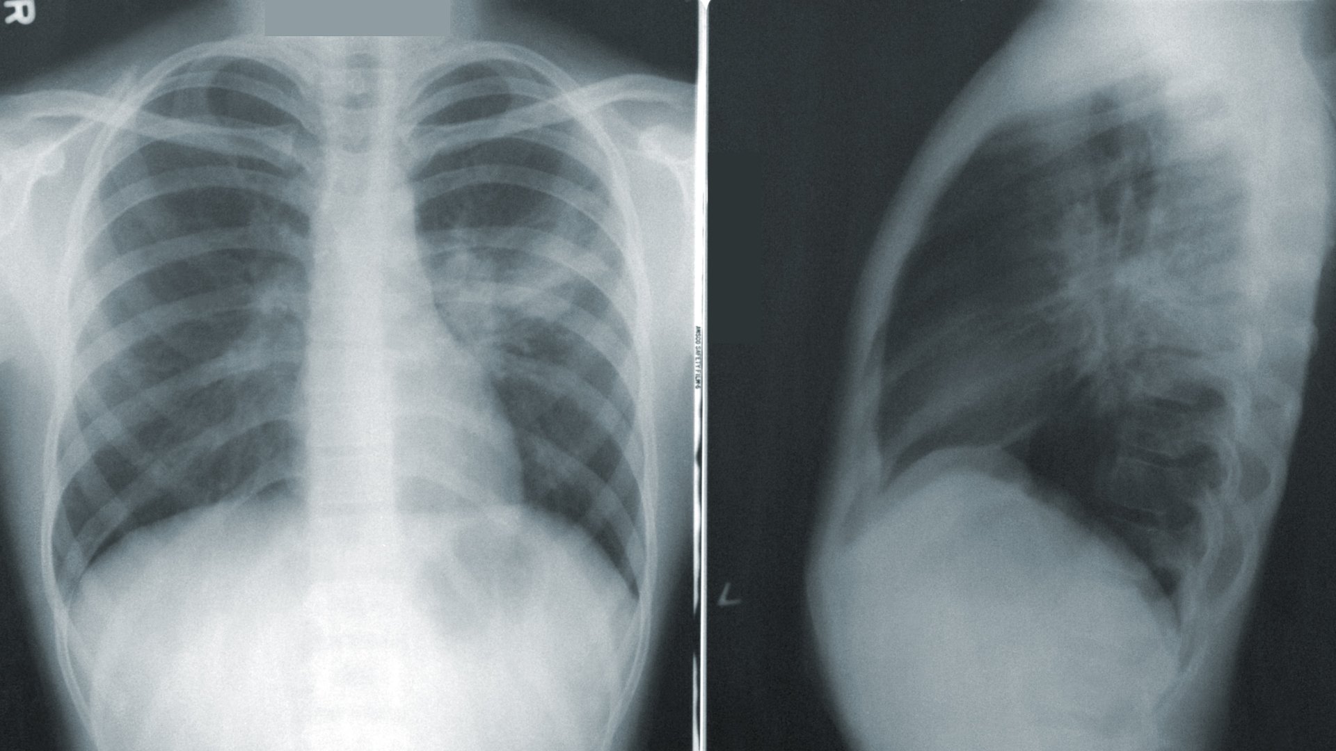 Tüdő röntgenfelvételen